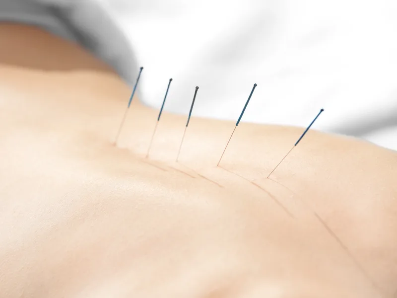 Acupuncture at Douglas DeSalvo Chiropractic, Inc. in NOVATO