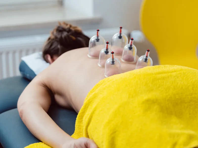 Cupping Therapy at Douglas DeSalvo Chiropractic, Inc. in NOVATO