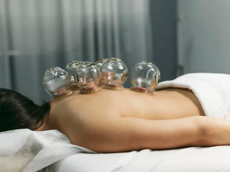 Cupping Therapy at Douglas DeSalvo Chiropractic, Inc. in NOVATO