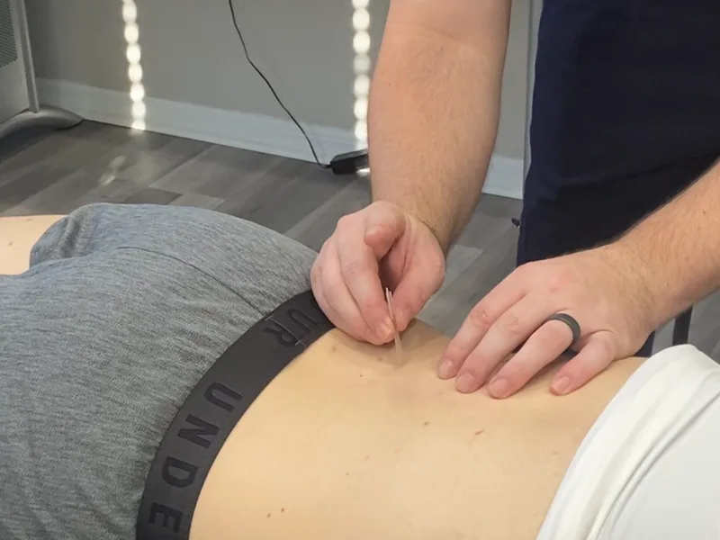 How Dry Needling works at Douglas DeSalvo Chiropractic, Inc.