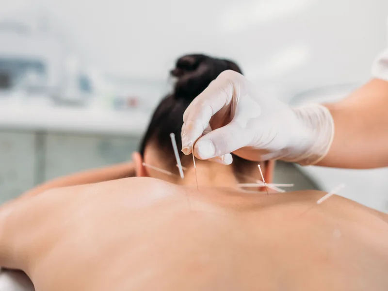 Dry Needling at Douglas DeSalvo Chiropractic, Inc. in NOVATO